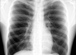 thorax röntgenfoto 