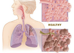 Normal_copd_versus_healthy_lung
