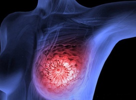 Rekenmodel kan bevolkingsonderzoek borstkanker efficiënter maken