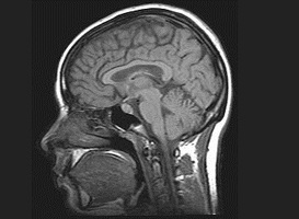 Normal_mri_brain_hersenen_neurologie_wiki_-c_