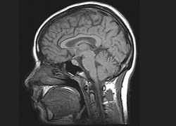 Hersenscan MRI