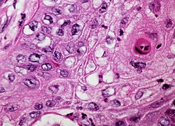 Normal_well_differentiated_squamous_cell_carcinoma_longkanker_kanker_cel_wiki_-c_