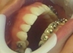 Normal_orto_orthodontist_tanden_beugel