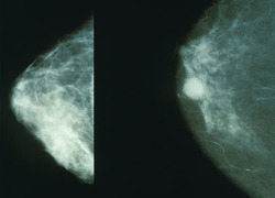 Normal_mammo_borst_kanker_mammogram