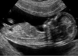Normal_embryo_at_12_weeks_zwangerschap_geboorte_wiki_-c_