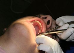 Normal_tandarts_kies_kiezen_tanden_trekken