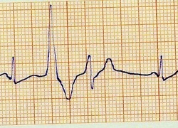 Normal_cardiogram_ecg