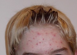Normal_akne-jugend_acne_jeugd_wiki_-c_