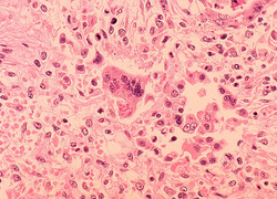 Normal_measles_pneumonia_-_histopathology_mazelen_wiki_-c_