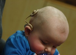 Normal_normal_infant_with_cochlear_implant