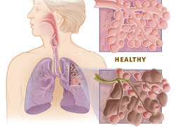 Normal_copd_versus_healthy_lung