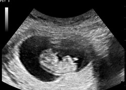 Normal_echo-baby-zwangerschap