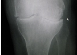 Normal_osteoarthritis_knee_artrose_knie