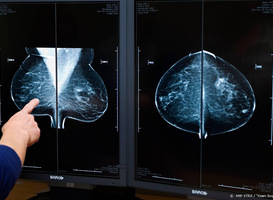 'Op termijn ruim 500 extra borstkankerdoden door coronacrisis'