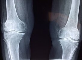 Meer aandacht voor osteoporose bij Nederlanders boven de 50 jaar