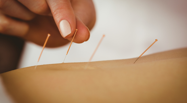 Carousel_young-woman-getting-acupuncture-treatment-in-thera-2021-08-28-16-10-49-utc