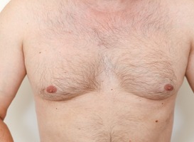 Mannen met vergrote borstklier lopen groter risico op vroegtijdig overlijden 