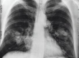 Aantal tuberculosepatiënten in 2021 toegenomen