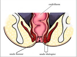 Aandacht voor verschil tussen aambeien en fissuur op Nationale Poepdag