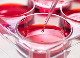 25-jarige man met MS gaat naar Mexico voor stamceltransplantatie